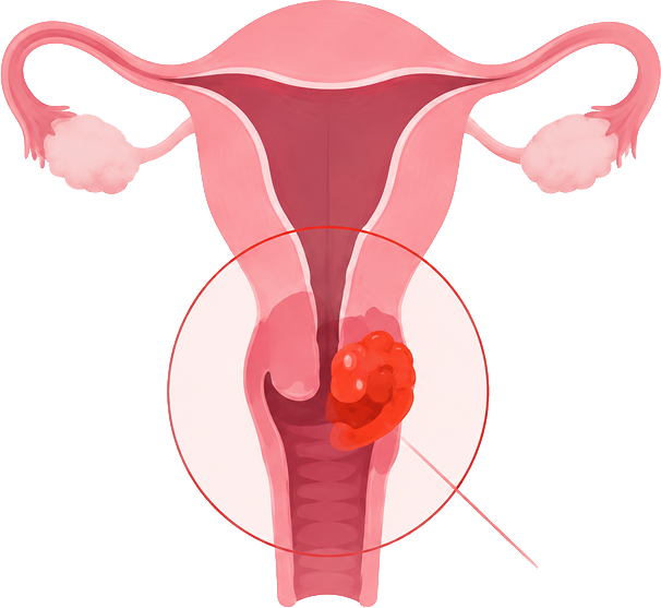 Illustration of advanced cervical cancer spread in the uterus