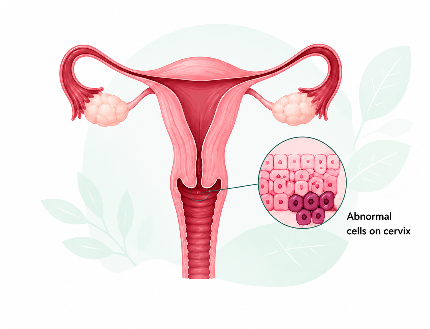 Medical illustration of the uterus with a magnified view showing abnormal cells on the cervix