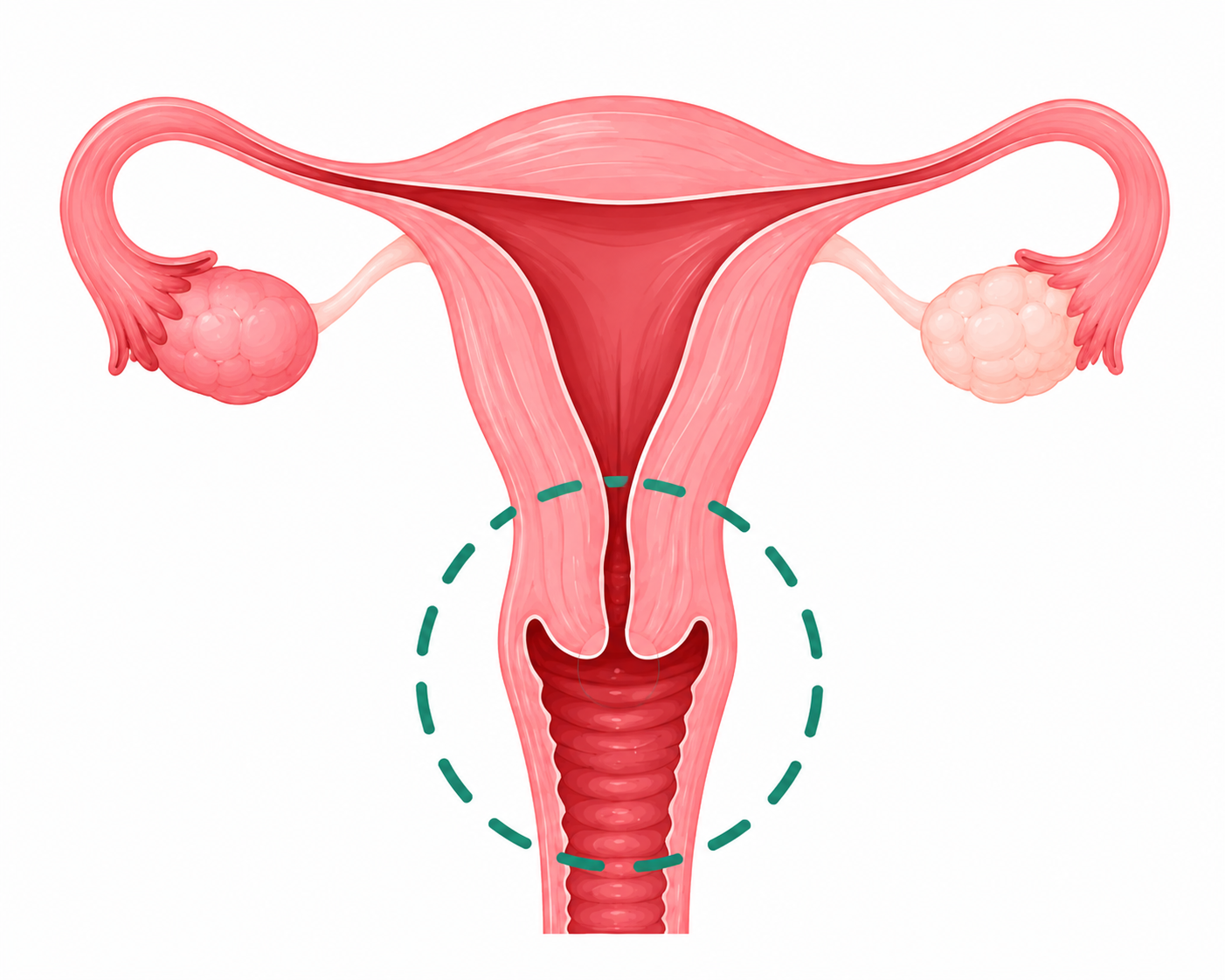 Illustration of the uterus highlighting where cervical cancer forms