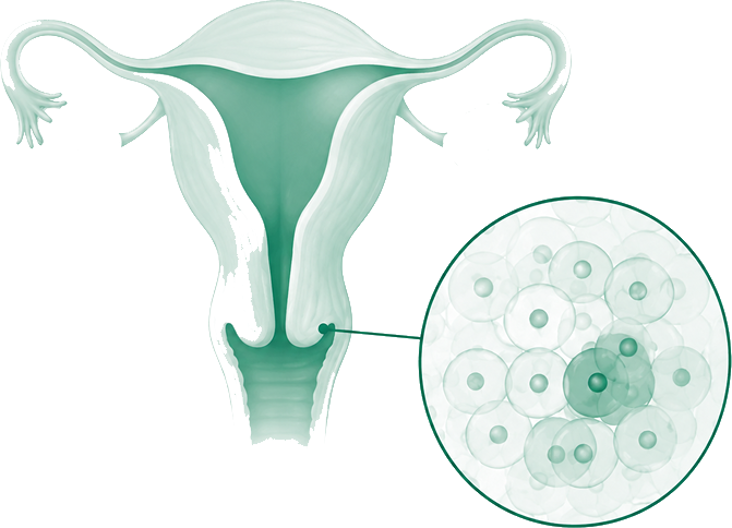 Illustration of early cervical cancer cells in the cervix